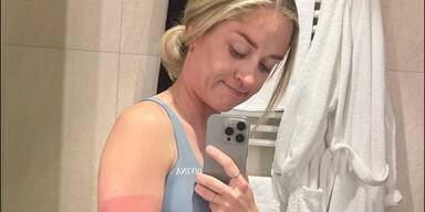 Autsch! ORF-Star Corinna Kamper zeigt verbrannte Haut auf Instagram
