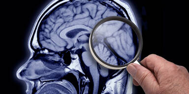 Jetzt kommt neuer Bluttest zur Alzheimer-Früherkennung