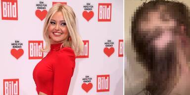 Patrice Aminati zeigt sich ohne Perücke: Mutig im Kampf gegen Krebs