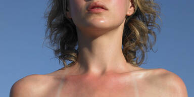 sonnenbrand_getty.jpg